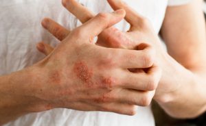 bollicine sulle mani: le cause