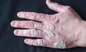 Artrite psoriasica