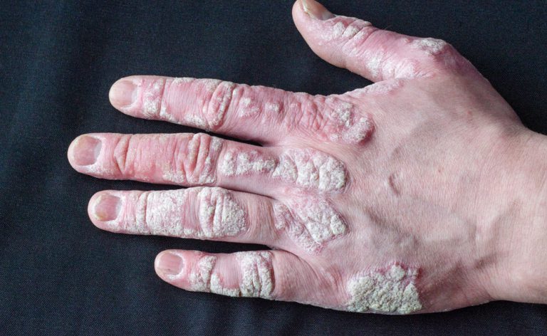 Artrite psoriasica: scoperto un nuovo trattamento che potrebbe essere più efficace