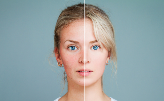 Caffeina, può ridurre i sintomi della rosacea: attenzione, però