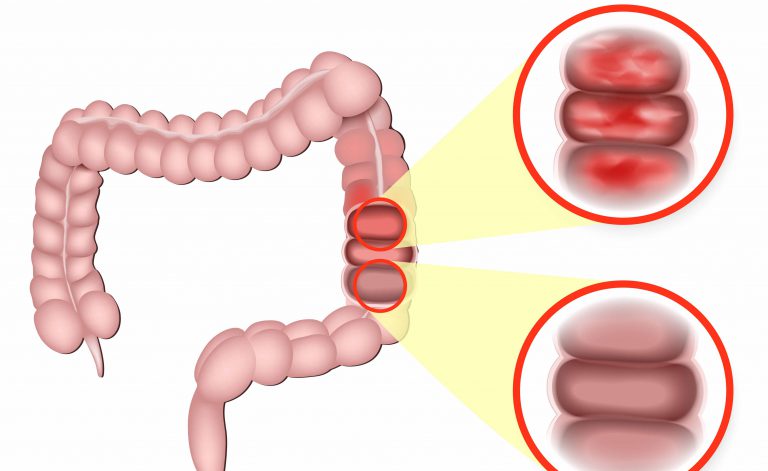 Malattia di Crohn: i farmaci biosimilari sono efficaci?