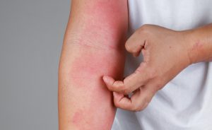 allergia al poliestere: come curarla