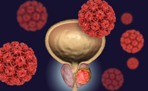 Come ridurre il rischio di cancro alla prostata