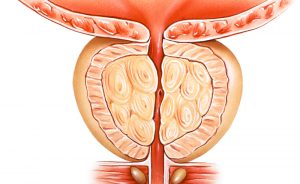 Ipertrofia Prostatica: gli Esercizi contro l'Incontinenza