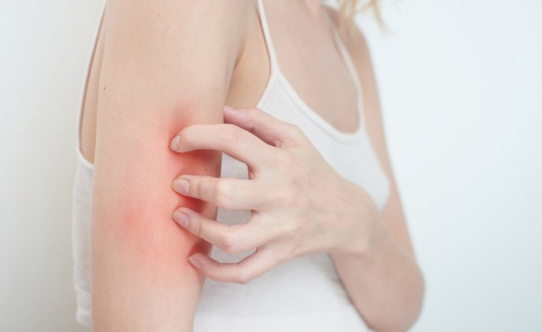 Eczema e prurito? Finalmente scoperta una nuova terapia per un sollievo immediato (e prolungato)!