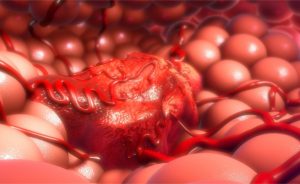 esami del sangue tumore