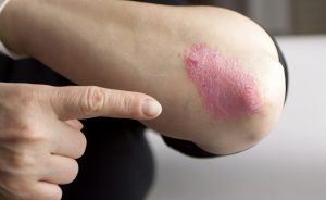 Il legame tra psoriasi e candida