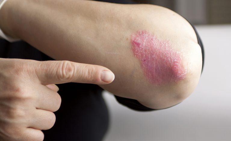 Candida e psoriasi: sì, c’è un legame