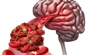 Vasculopatia cerebrale: i sintomi e le cure