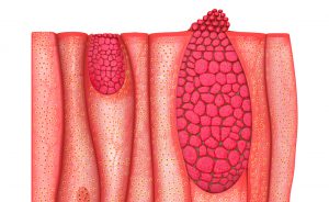 epitelioma basocellulare