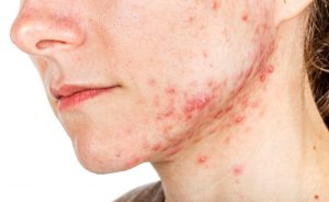 Funziona il dentifricio sui brufoli?