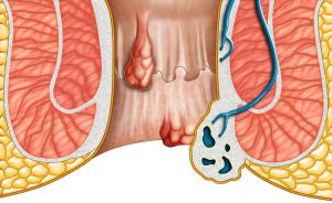 Cosa mangiare e cosa evitare con le emorroidi