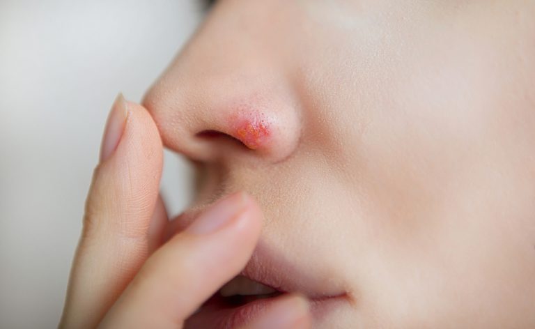 Come curare (e nascondere) l’Herpes al naso