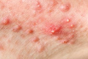 Rimedi naturali per l'acne cistica: quali sono?