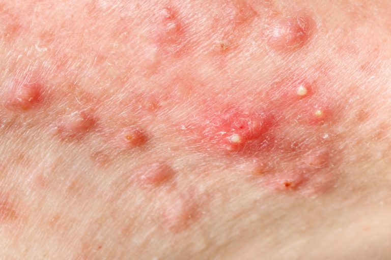 Acne cistica: come trattarla al meglio