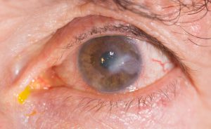 Cause della cheratite, l'infiammazione della cornea