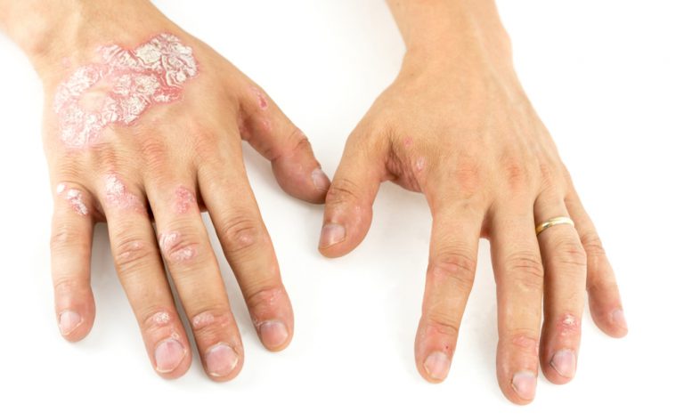 Psoriasi e malattie cardiache: il legame (positivo)