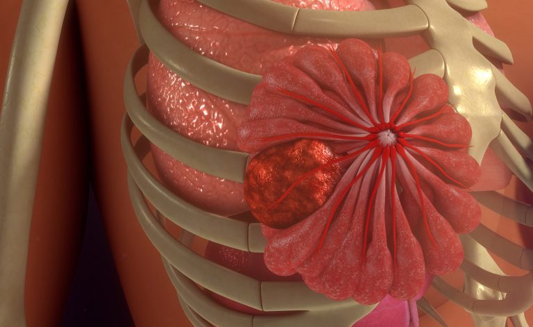Vitamina D: un fattore di protezione per il tumore al seno
