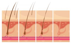 Caduta dei capelli e Chemioterapia