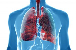 Quali sono i Fattori di rischio del tumore al polmone?