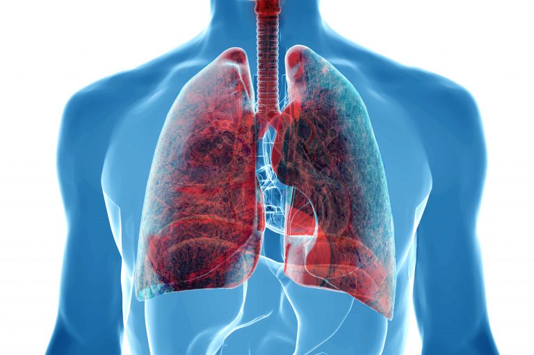 Il fumo di sigaretta non è l’unica causa di tumore al polmone, anzi