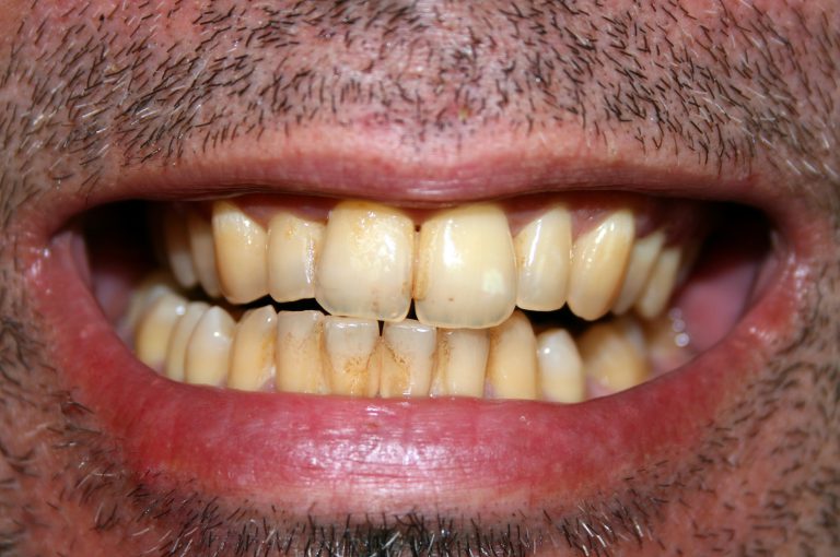 Sotto accusa i prodotti per sbiancare i denti: i risultati di una nuova ricerca