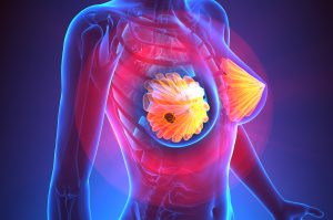 Deodoranti e tumore al seno: qual è la correlazione?