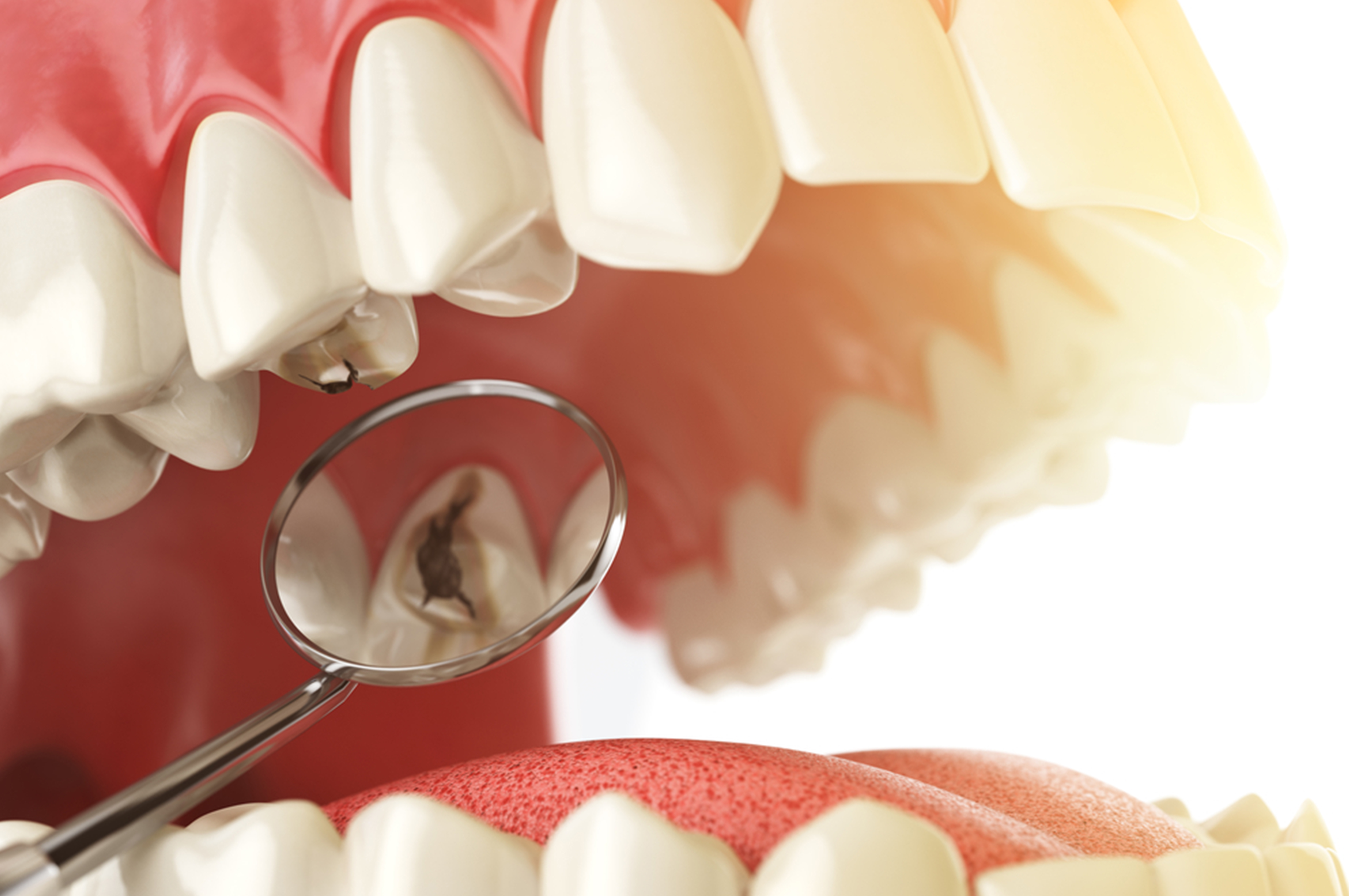 Siete certi che quel dolorino al dente non sia una carie?