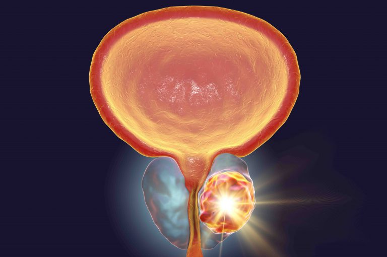 il significato del termine medico prostatite è infiammazione di: il significato del termine medico prostatite è infiammazione di: